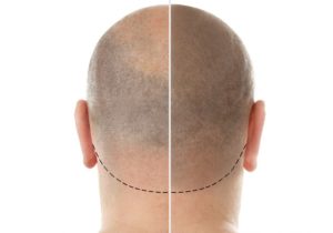 prp-eigenbluttherapie-haare-dortmund-rueckseite-300x210 Eigenbluttherapie in der Praxis in Dortmund