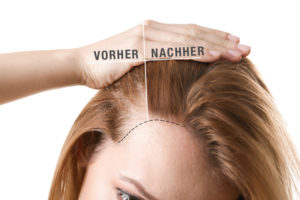 Eigenbluttherapie vorher nachher