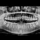 Nervlateralisation