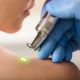 Removal of good-quality birthmarks and warts. The girl on a session laser therapy.