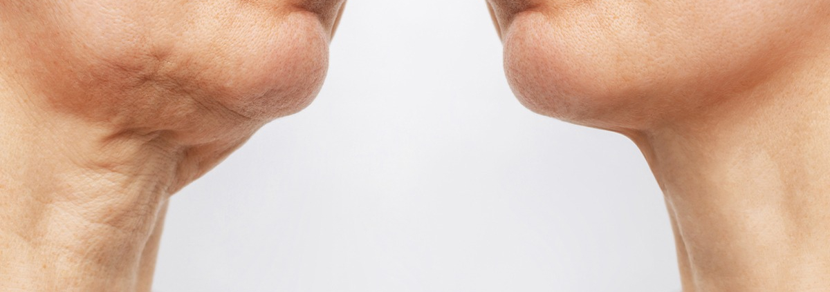 Halslifting vorher nachher Bild