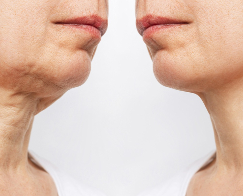 Halslifting vorher nachher Bild